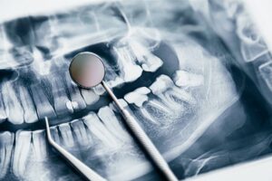 extraer muelas para ortodoncia