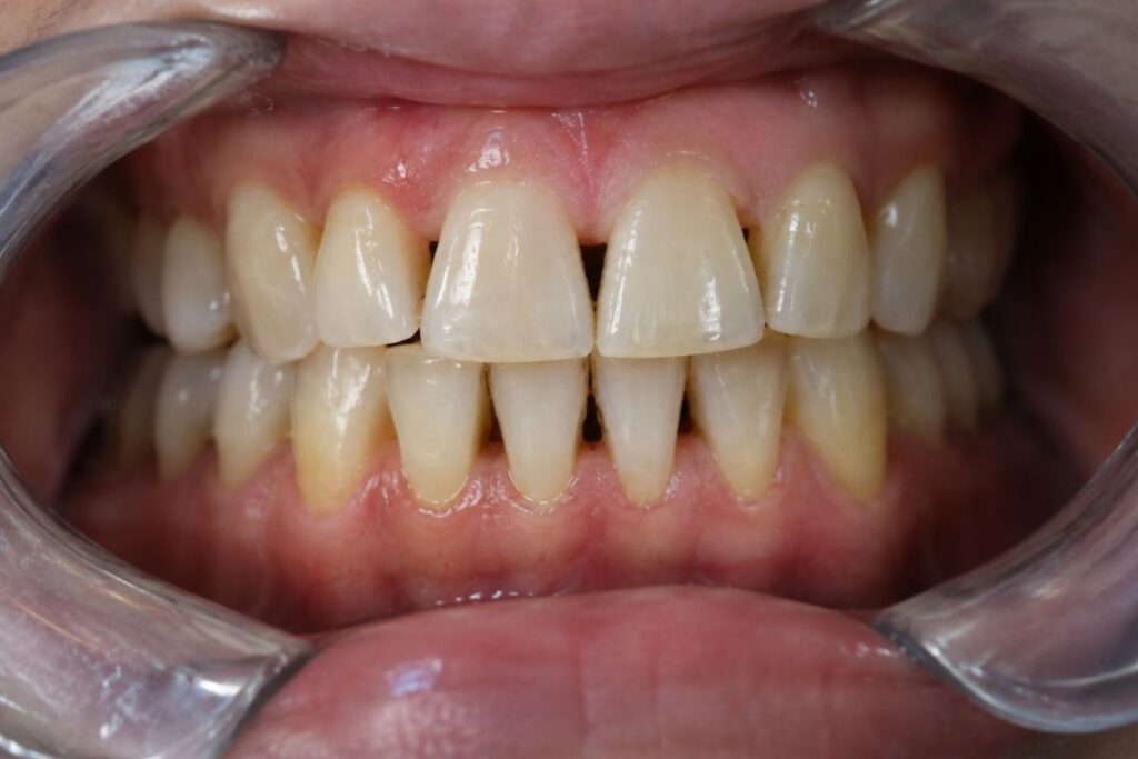 troneras dentales